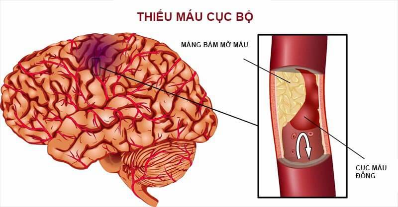 Có thể có tình trạng thiếu máu cục bộ vùng ruột, não hoặc thận và phù phổi cấp